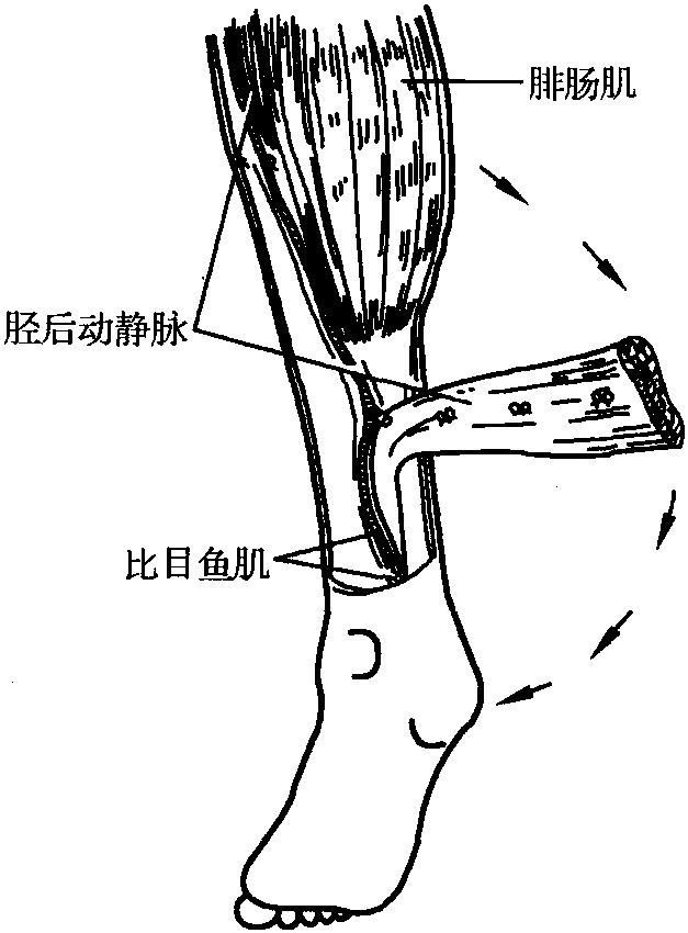 比目鱼肌肌皮瓣 王成琪显微外科 医学